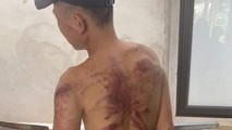 Anh T.Q.H bị Lê Thị Hiền dùng dây điện đánh thâm tím người.
