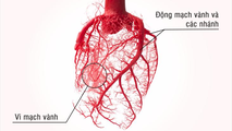 Bệnh mạch vành: Giải pháp nào hỗ trợ cải thiện đau tức ngực, thiếu máu tim?