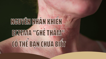 Nguyên nhân khiến eczema “ghé thăm” có thể bạn chưa biết