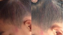 Vết đỏ hằn trên đầu học sinh Đức