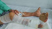 Bệnh nhân Gout điều trị tại Bệnh viện Chợ Rẫy. Ảnh: BVCC