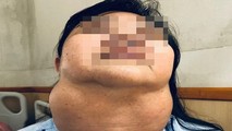 Bà N. với khối bướu cổ to như trái dưa trước khi phẫu thuật. Ảnh: BVCC