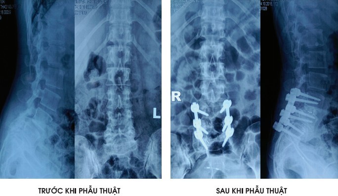 Kỳ diệu: Mổ cột sống không còn sợ bị liệt Kỳ diệu: Mổ cột sống không còn sợ bị liệt