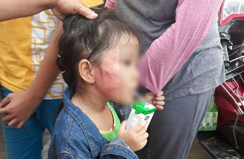 {title} Bé gái 5 tuổi nghi bị bảo mẫu tát sưng mặt ở Sài Gòn