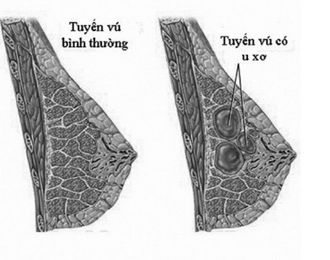 U xơ tuyến vú là một bệnh lành tính. U xơ tuyến vú là một bệnh lành tính.
