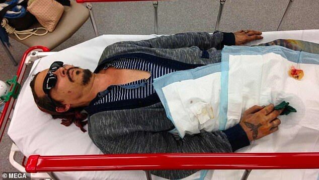 Johnny Depp bị thương ở tay và mặt vào tháng 3/2015.