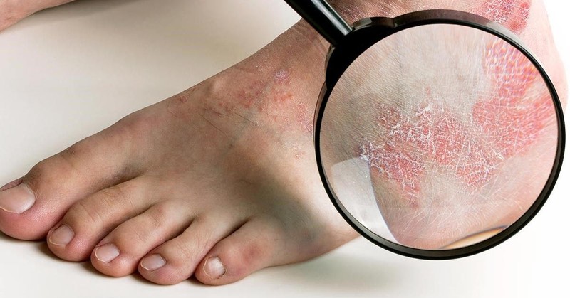 6 bệnh thường gặp sau mưa lũ và biện pháp điều trị ảnh 2