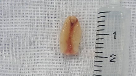 Hạt lạc sau khi được phẫu thuật lấy ra khỏi đường thở của bé