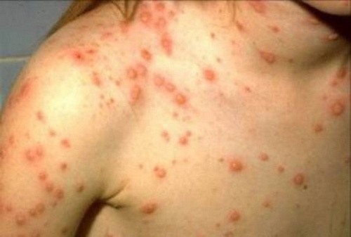 Ban thủy đậu là ban bọc nước, mọc toàn thân còn ban sởi là ban nhỏ mỏng trên mặt da, mọc theo thứ tự mặt, lan xuống chân. Ban thủy đậu là ban bọc nước, mọc toàn thân còn ban sởi là ban nhỏ mỏng trên mặt da, mọc theo thứ tự mặt, lan xuống chân.