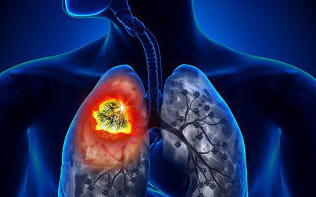 70% bệnh nhân ung thư phổi nam chết do hút thuốc lá.