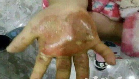 Mẹ nhúng tay con gái vào nước sôi rồi rắc muối