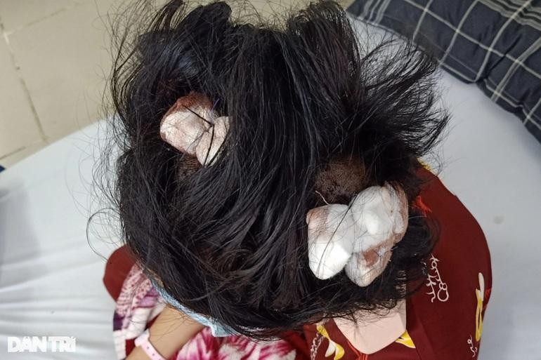 Bé gái 16 tuổi bị người tình của mẹ vụt gậy sắt đến bất tỉnh ảnh 1