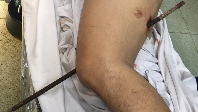 Ngã từ độ cao 5 mét xuống đất, nam thanh niên bị thanh sắt đâm xuyên đùi