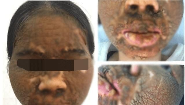 Ham trắng da, cô gái 24 tuổi mặt biến dạng sân sùi như vỏ cây