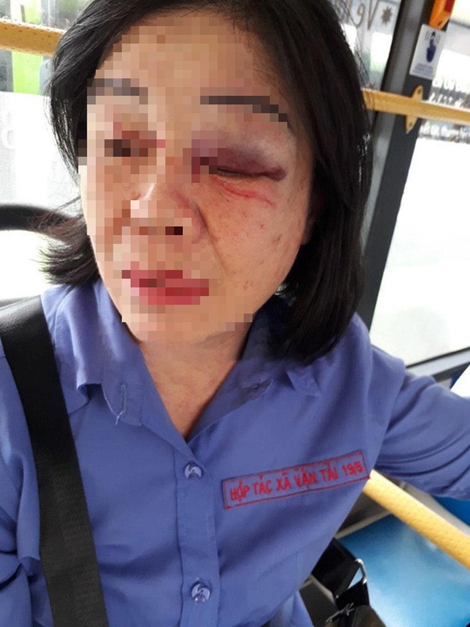 TP HCM: Nữ tiếp viên xe buýt bị hành khách đấm bầm mắt - Ảnh 1. TP HCM: Nữ tiếp viên xe buýt bị hành khách đấm bầm mắt - Ảnh 1.