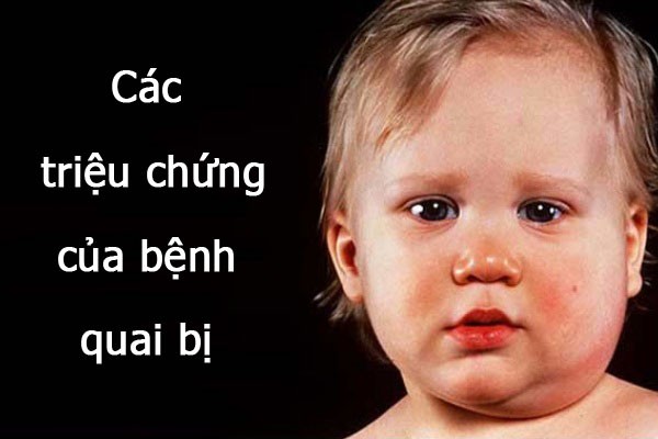 Đừng chủ quan với bệnh quai bị