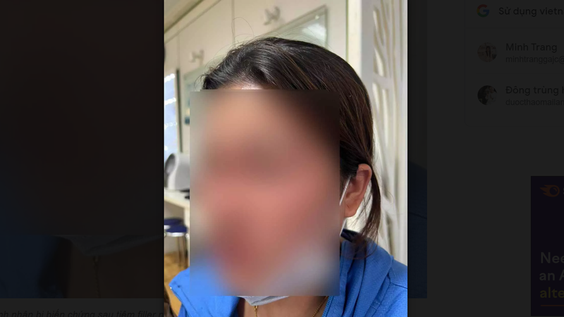 Nữ bệnh nhân bị biến chứng sau tiêm filler nâng mũi để thay đổi vận mệnh- Ảnh: Vietnamnet