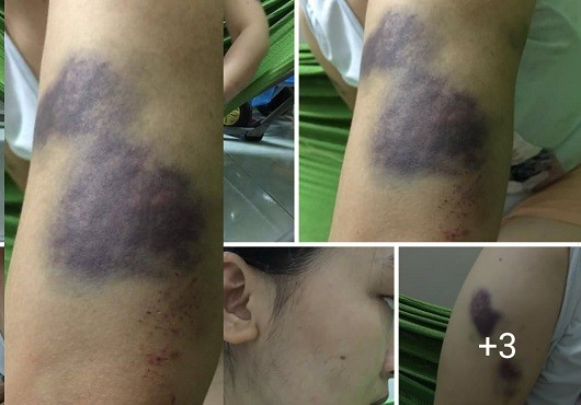 Thương tích của chị Hoàng Thị Mai